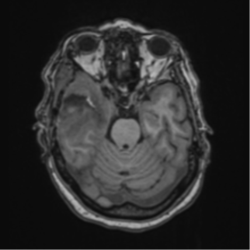 Atypical meningioma (WHO Grade II) (Radiopaedia 54742-60981 Axial T1 23).png