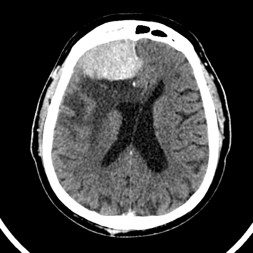 Atypical meningioma (WHO grade II) with brain invasion (Radiopaedia 57767-64728 Axial C+ 24).png