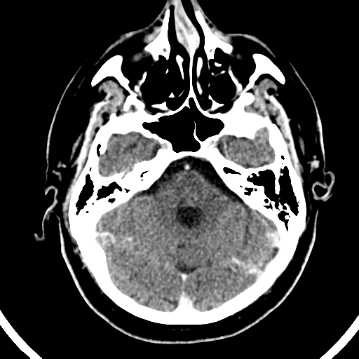 Atypical meningioma (WHO grade II) with brain invasion (Radiopaedia 57767-64728 Axial C+ 41).png