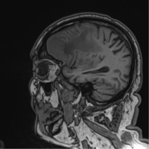 Atypical meningioma (WHO grade II) with brain invasion (Radiopaedia 57767-64729 Sagittal T1 48).png