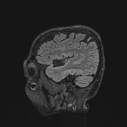 Autoimmune limbic encephalitis (Radiopaedia 30363-31005 Sagittal FLAIR 40).jpg