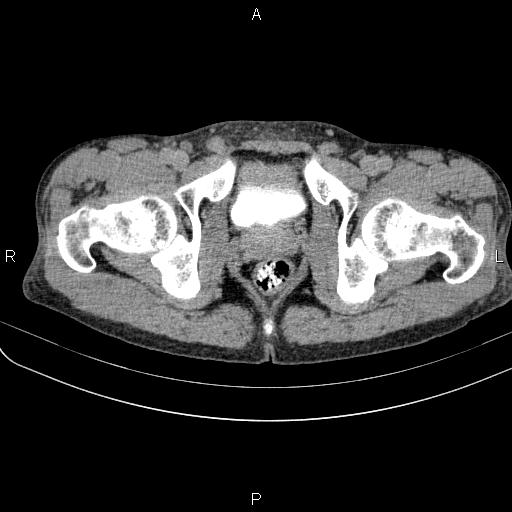 Autoimmune pancreatitis (Radiopaedia 84925-100431 Axial C+ delayed 97).jpg