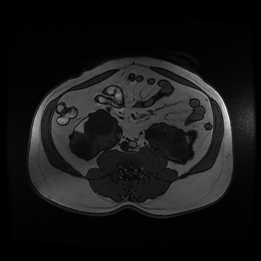 Autosomal dominant polycystic kidney disease (Radiopaedia 50259-55611 Axial 2D Dual Echo 61).jpg