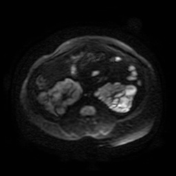 Autosomal dominant polycystic kidney disease (Radiopaedia 50259-55611 Axial DWI 100).jpg