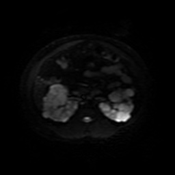 Autosomal dominant polycystic kidney disease (Radiopaedia 50259-55611 Axial DWI 22).jpg