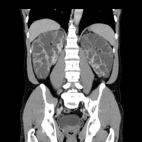 Autosomal dominant polycystic kidney disease (Radiopaedia 66349-75582 A 60).jpg