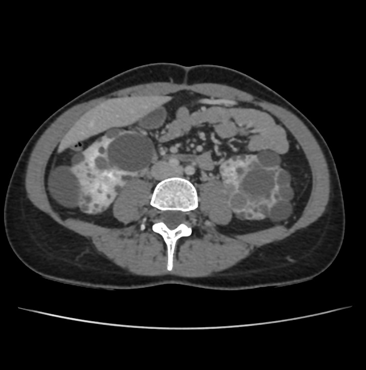 Autosomal dominant polycystic kidney disease - early onset (Radiopaedia 40734-43387 A 49).jpg