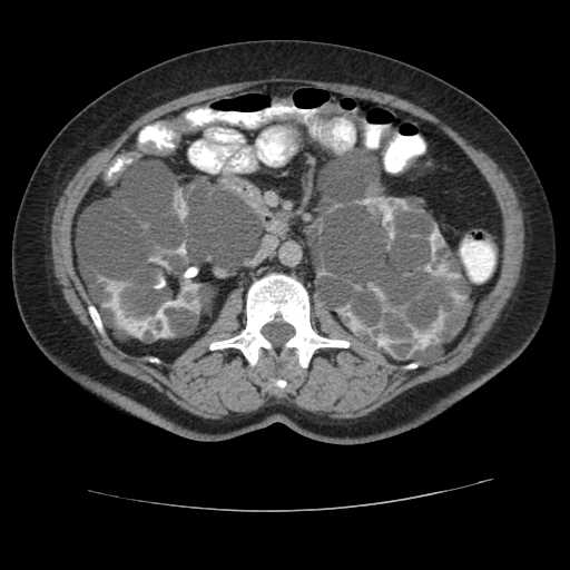 Autosomal dominant polycystic kidney disease with hepatic involvement (Radiopaedia 32693-33662 C 36).jpg