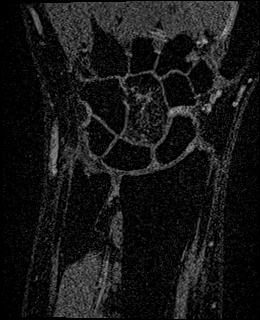 Avascular necrosis of the capitate (Radiopaedia 88317-104948 Coronal T1 vibe 36).jpg