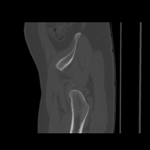 Avascular necrosis of the hip (Radiopaedia 61503-69467 B 9).jpg