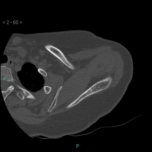 Avascular necrosis of the shoulder - Cruess stage I (Radiopaedia 77674-89887 Axial bone window 15).jpg
