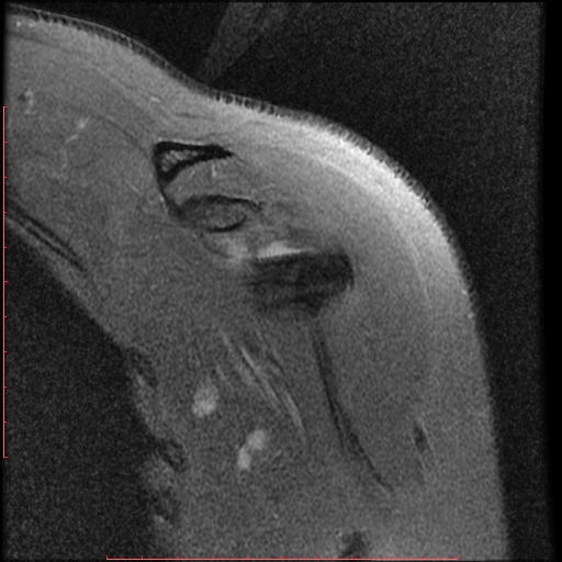 File:Avulsion fracture - greater tuberosity of humerus (Radiopaedia 25457-25703 Coronal PD 2).jpg