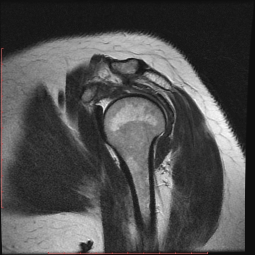 File:Avulsion fracture - greater tuberosity of humerus (Radiopaedia 25457-25703 Sagittal T2 6).jpg