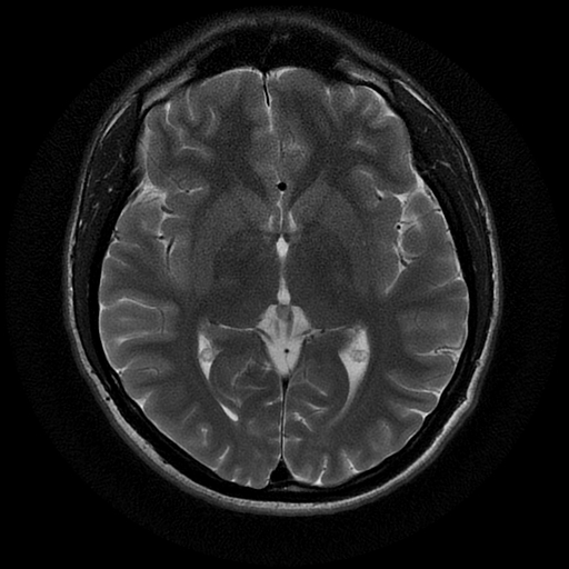 File:Azygos anterior cerebral artery (Radiopaedia 17059-16756 Axial T2 13).jpg