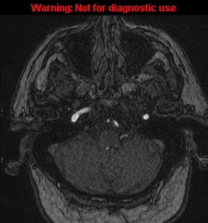 Azygos anterior cerebral artery (Radiopaedia 59325-66677 Axial MRA 23).jpg