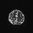 File:Balo concentric sclerosis (Radiopaedia 50458-55940 Axial DWI 4).jpg