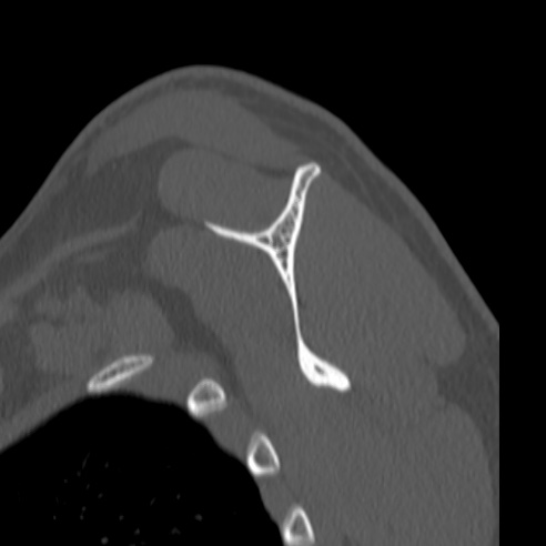 Bankart lesion (Radiopaedia 57256-64185 Sagittal bone window 44).jpg
