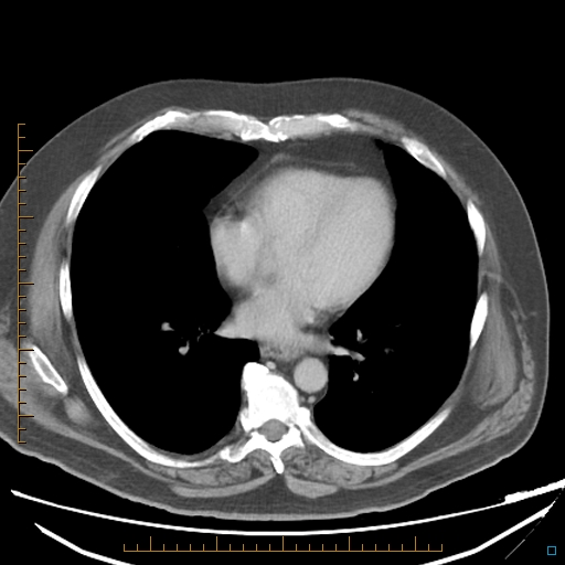 File:Bariatric balloon causing gastric outlet obstruction (Radiopaedia 54449-60672 A 1).jpg