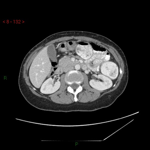 Bartholin gland cyst (Radiopaedia 54904-61181 A 33).jpg