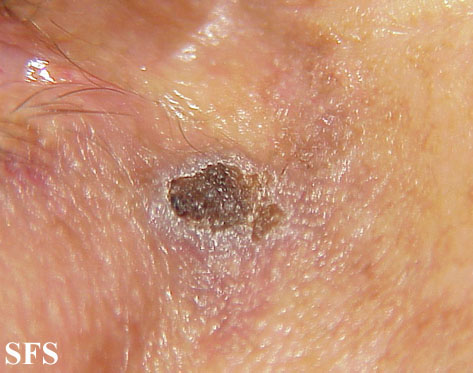Basal Cell Carcinoma (Dermatology Atlas 76).jpg