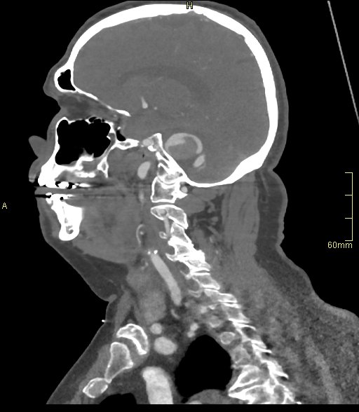 Basilar artery aneurysm (Radiopaedia 56261-62932 C 17).jpg