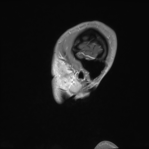 Basilar artery perforator aneurysm (Radiopaedia 82455-97733 G 137).jpg