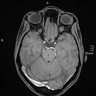 Basilar artery perforator aneurysm (Radiopaedia 82455-99523 F 49).jpg