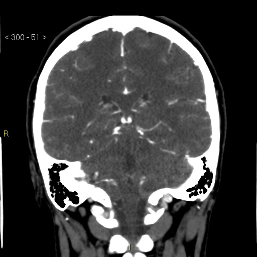 File:Basilar artery thrombosis (Radiopaedia 16260-15944 B 42).jpg