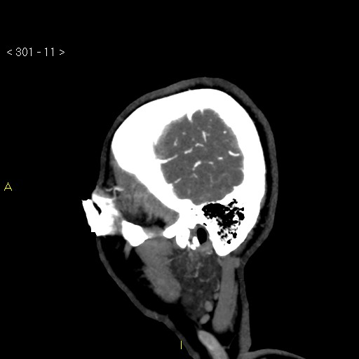 Basilar artery thrombosis (Radiopaedia 16260-15944 C 5).jpg