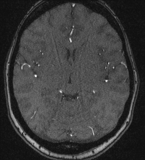 File:Basilar tip aneurysm (Radiopaedia 26504-26632 MRA 119).jpg