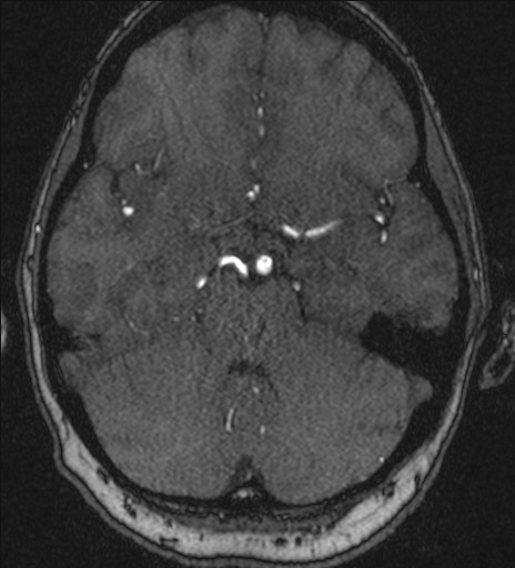 Basilar tip aneurysm (Radiopaedia 26504-26632 MRA 79).jpg