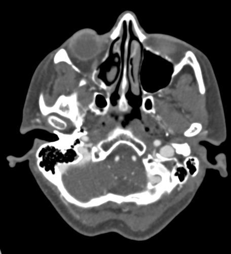 File:Basilar tip aneurysm with coiling (Radiopaedia 53912-60086 A 25).jpg