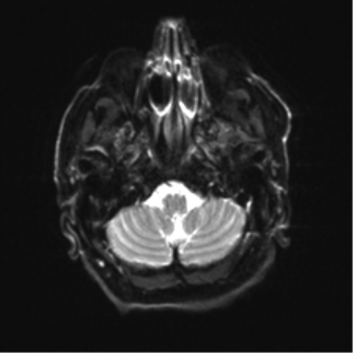 File:Behavioral variant frontotemporal dementia and late onset schizophrenia (Radiopaedia 52197-58083 Axial DTI Trace W 4).png