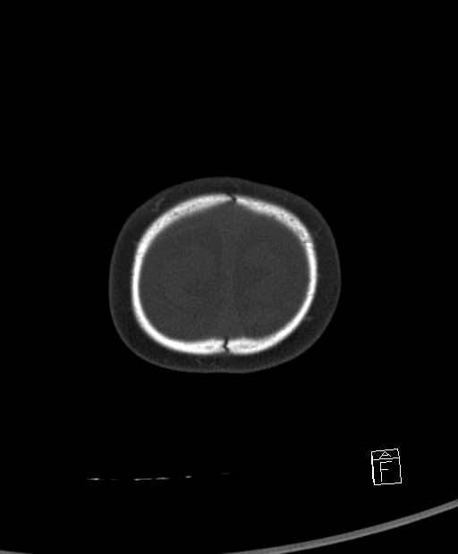 Benign enlargement of subarachnoid spaces in infancy (BESS) (Radiopaedia 87459-103795 Axial bone window 4).jpg