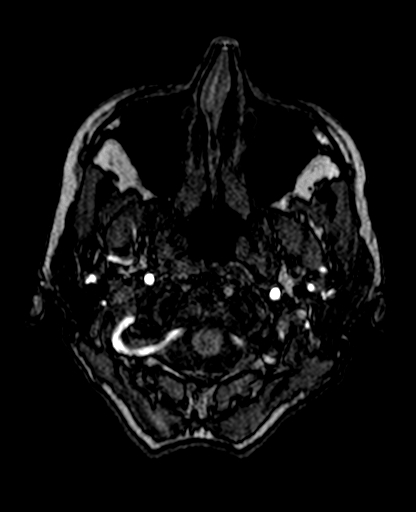 Berry aneurysm of the terminal internal carotid artery (Radiopaedia 88286-104918 Axial TOF 36).jpg