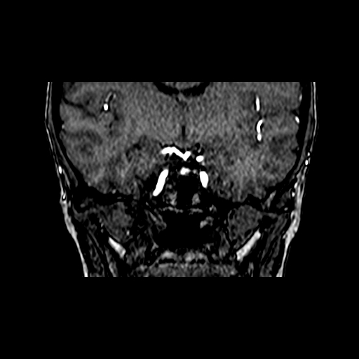 Berry aneurysm of the terminal internal carotid artery (Radiopaedia 88286-104918 Coronal TOF 44).jpg