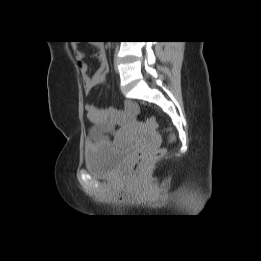 File:Bicornuate uterus- on MRI (Radiopaedia 49206-54296 A 11).jpg