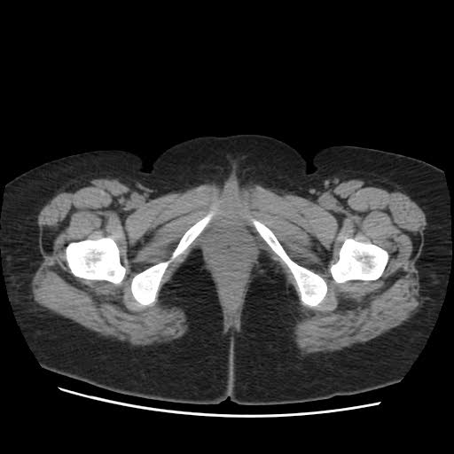 File:Bicornuate uterus- on MRI (Radiopaedia 49206-54296 Axial non-contrast 17).jpg