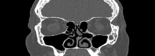 Bilateral Ectopic Infraorbital Nerves (Radiopaedia 49006-54084 Coronal bone window 29).jpg