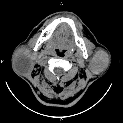 Bilateral Warthin tumors (Radiopaedia 84034-99263 Axial non-contrast 23).jpg