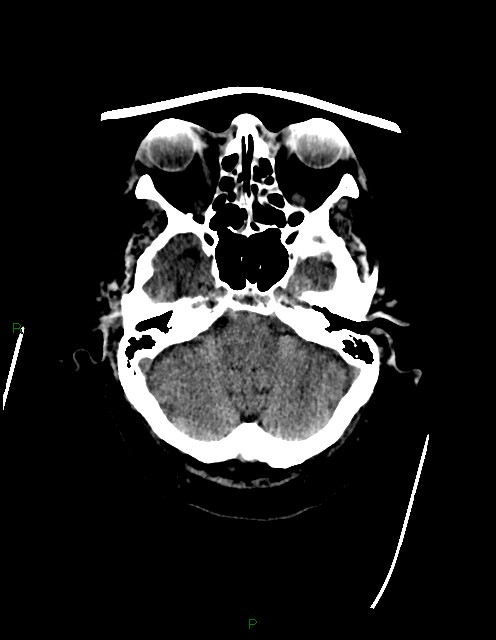 Bilateral acute middle cerebral artery territory infarcts (Radiopaedia 77319-89401 Axial non-contrast 17).jpg