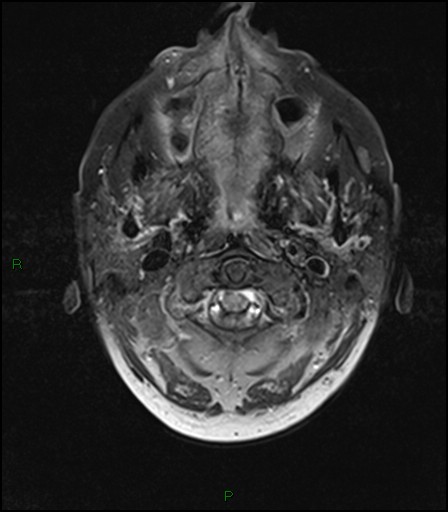 File:Bilateral acute middle cerebral artery territory infarcts (Radiopaedia 77319-89402 Axial FLAIR 1).jpg