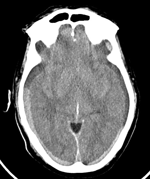 Bilateral acute on chronic subdural hematomas (Radiopaedia 78466-91146 Axial non-contrast 27).jpg