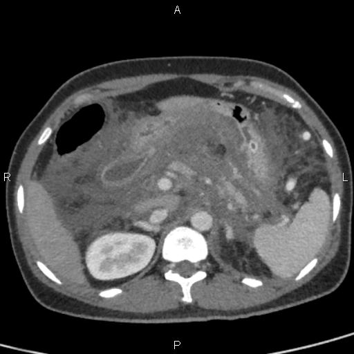 File:Bilateral adrenal gland hyperenhancement in pancreatitis (Radiopaedia 86642-102753 E 29).jpg