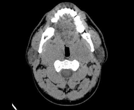 Bilateral carotid body tumors (Radiopaedia 61841-69870 Axial non-contrast 31).jpg