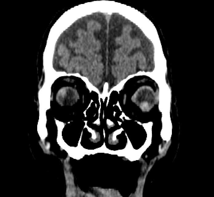 Bilateral ectopia lentis (Radiopaedia 89889-107013 Coronal non-contrast 49).jpg