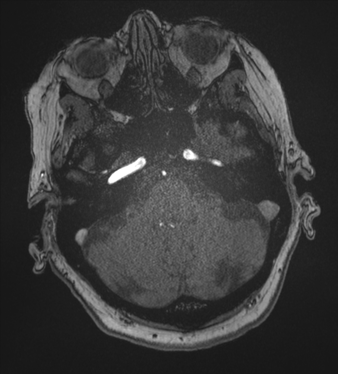 Bilateral fetal posterior communicating arteries (Radiopaedia 41286-44102 Axial MRA 36).png