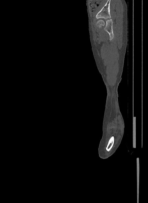 Bilateral fibular hemimelia type II (Radiopaedia 69581-79491 Sagittal bone window 61).jpg