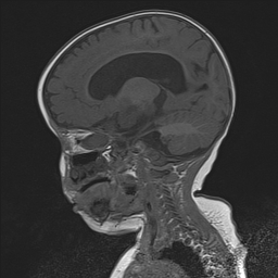 File:Bilateral optic pathway gliomas (Radiopaedia 40013-42514 Sagittal T1 19).jpg