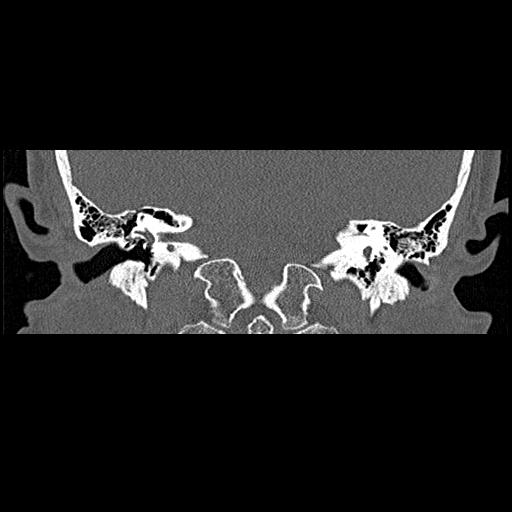 File:Bilateral ossifications of the external auditory canal (Radiopaedia 15233-15076 Coronal bone window 14).jpg